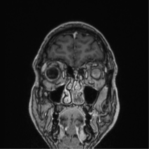 File:Colloid cyst of the third ventricle (Radiopaedia 86571-102662 Coronal T1 C+ 79).png
