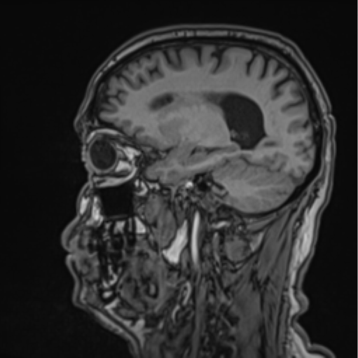 File:Colloid cyst of the third ventricle (Radiopaedia 86571-102662 Sagittal T1 52).png