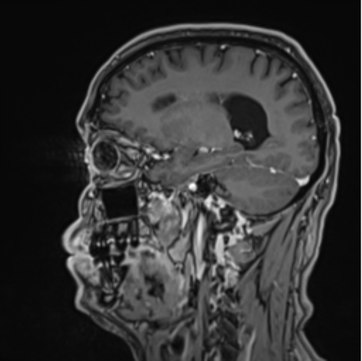 File:Colloid cyst of the third ventricle (Radiopaedia 86571-102662 Sagittal T1 C+ 52).png
