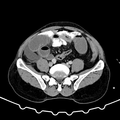 File:Colocolic intussusception due to large lipoma (Radiopaedia 68773-78482 A 132).jpg
