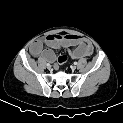 File:Colocolic intussusception due to large lipoma (Radiopaedia 68773-78482 A 146).jpg