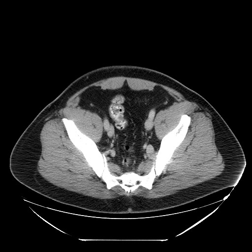 File:Colocolic intussusception due to lipoma (Radiopaedia 73712-84508 Axial 98).jpg