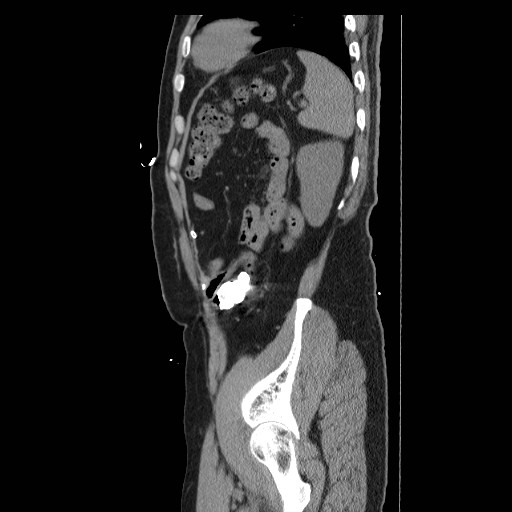 Colocutaneous fistula in Crohn's disease (Radiopaedia 29586-30093 F 43).jpg