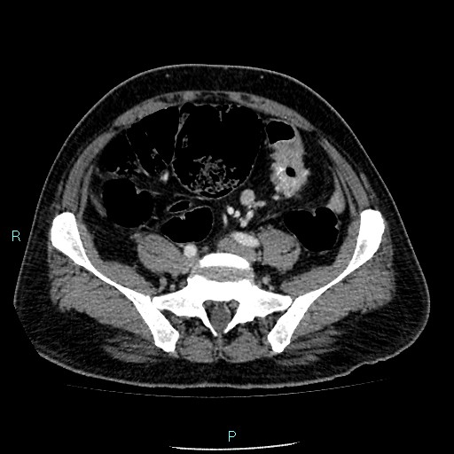 Colon adenocarcinoma with calcific liver metastasis (Radiopaedia 55745-62300 B 32).jpg