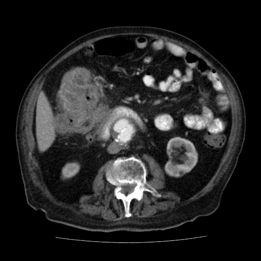File:Colon cancer with duodenal invasion (Radiopaedia 16278-15958 A 30).jpg