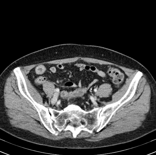 Colon carcinoma with hepatic metastases (Radiopaedia 29477-29961 A 88).jpg