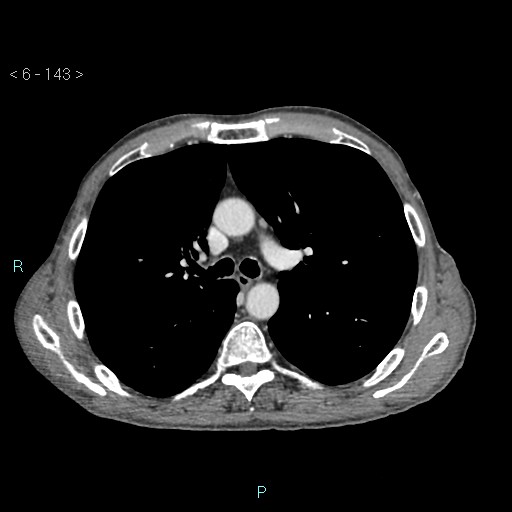 File:Colonic cancer (ultrasound and TC imaging) (Radiopaedia 50346-55713 B 143).jpg