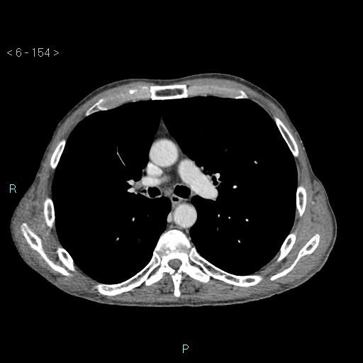 File:Colonic cancer (ultrasound and TC imaging) (Radiopaedia 50346-55713 B 154).jpg