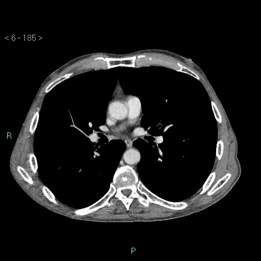 Colonic cancer (ultrasound and TC imaging) (Radiopaedia 50346-55713 B 185).jpg