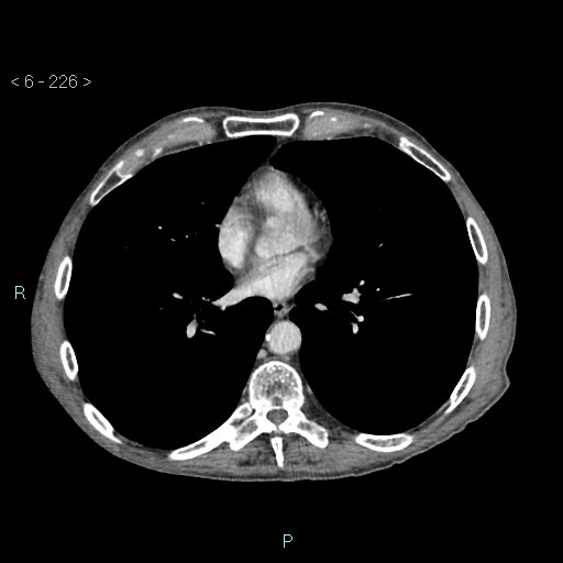 File:Colonic cancer (ultrasound and TC imaging) (Radiopaedia 50346-55713 B 226).jpg