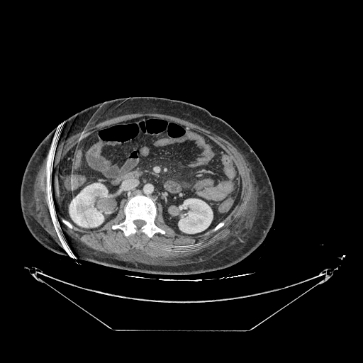 Colonic infarction after colostomy creation (Radiopaedia 81157-94797 A 75).jpg