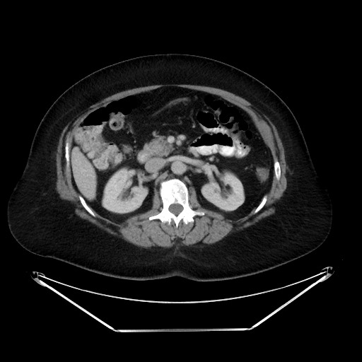 File:Colonic intussusception due to adenocarcinoma (Radiopaedia 86828-102987 A 60).jpg