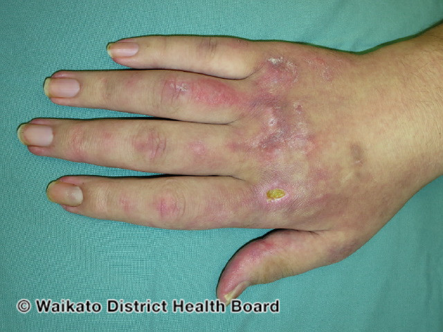 File:Dermatomyositis (DermNet NZ dermatomyositis).jpg