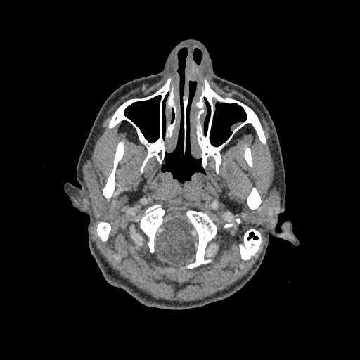 File:Nasal pyogenic granuloma (lobular capillary hemangioma) (Radiopaedia 85536-101244 C 35).jpg