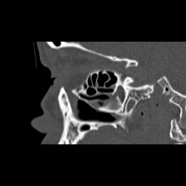 Nasal septal perforation (Radiopaedia 25030-25289 Sagittal bone window 48).jpg