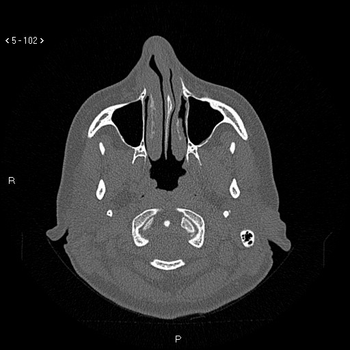 Nasolabial cyst (Radiopaedia 75125-86194 Axial bone window 63).jpg
