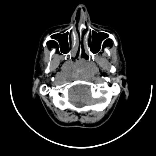 Nasopharyngeal carcinoma - infiltrating the clivus (Radiopaedia 62583-70875 Axial non-contrast 16).jpg