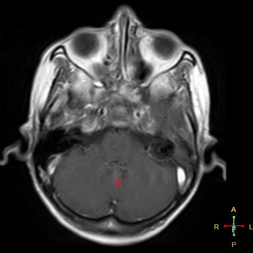 File:Nasopharyngeal carcinoma infiltrating the clivus (Radiopaedia 25229-25481 Axial T1 C+ 8).jpg