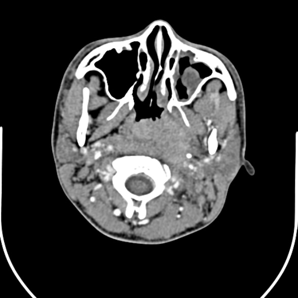 File:Nasopharyngeal carcinoma with skull base invasion (Radiopaedia 53415-59705 A 58).jpg