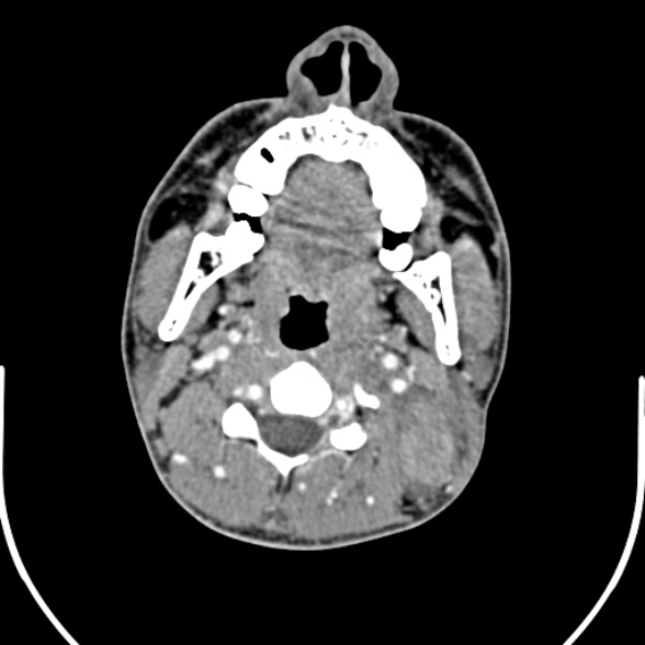 Nasopharyngeal carcinoma with skull base invasion (Radiopaedia 53415-59705 A 92).jpg