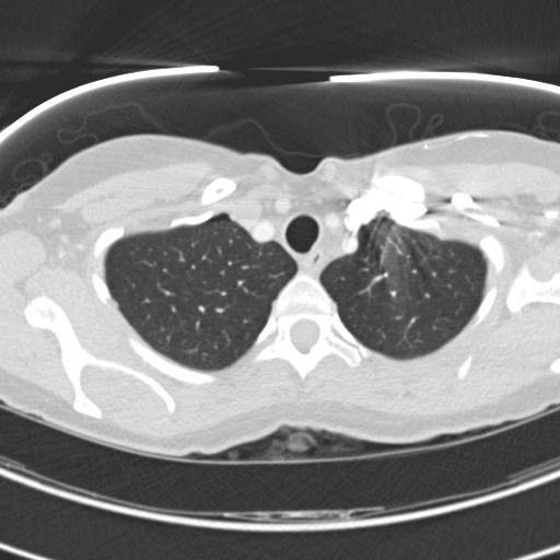 Necrobiotic pulmonary nodules - Crohn disease (Radiopaedia 20723-20631 Axial lung window 23).jpg
