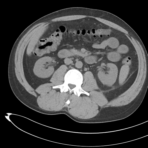 File:Necrotizing pancreatitis with acute necrotic collections (Radiopaedia 38829-41012 Axial non-contrast 40).png