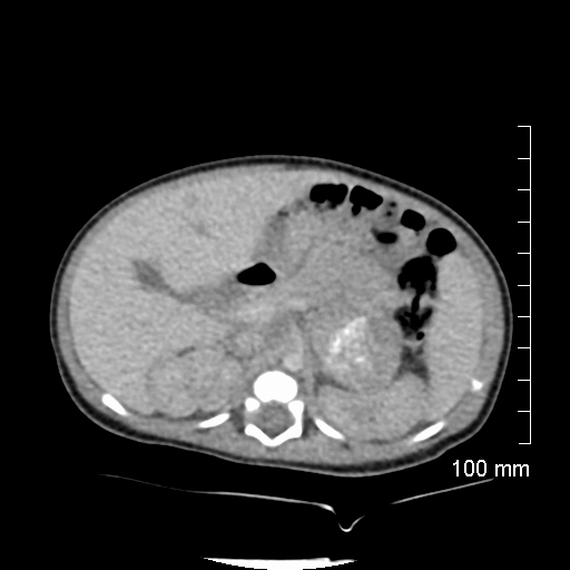 File:Neonatal neuroblastoma (Radiopaedia 56651-63438 Axial non-contrast 30).jpg