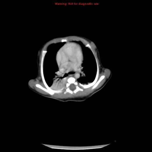 File:Neonatal neuroblastoma (Radiopaedia 9564-10223 A 7).jpg