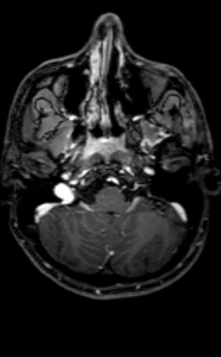 Neuro-Behçet disease (Radiopaedia 90112-107294 Axial T1 C+ 179).jpg