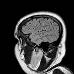 File:Neuro-Behcet's disease (Radiopaedia 21557-21506 Sagittal FLAIR 3).jpg