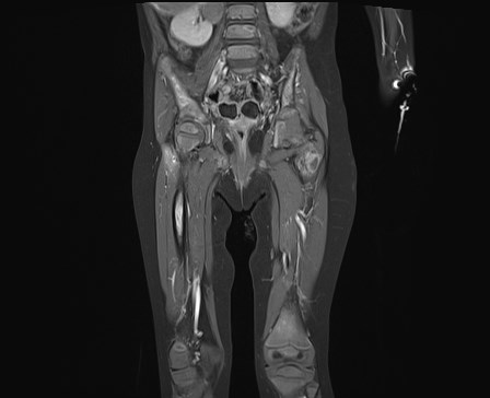 File:Neuroblastoma with bone metastases (Radiopaedia 67080-76414 E 13).jpg