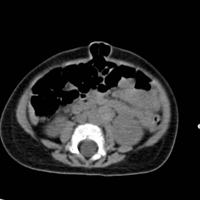 Neuroblastoma with skull metastases (Radiopaedia 30326-30960 Axial non-contrast 36).jpg