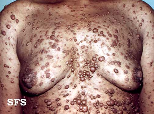 File:Neurofibromatosis (Dermatology Atlas 1).jpg