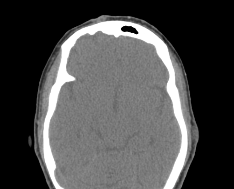 Neurofibromatosis type 1- orbital manifestations (Radiopaedia 49391-54511 Axial non-contrast 69).jpg