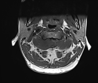 File:Neurofibromatosis type 1 (Radiopaedia 80355-93740 Axial T1 6).jpg