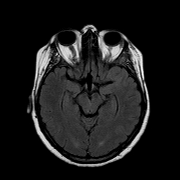 File:Neurofibromatosis type 2 (Radiopaedia 8713-9518 Axial FLAIR 15).jpg