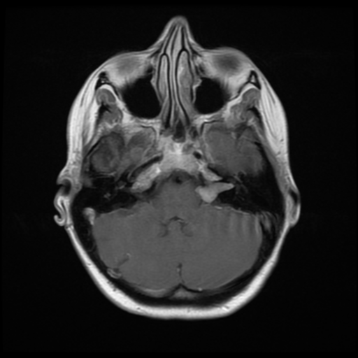 File:Neurofibromatosis type 2 - bilateral acoustic neuromata (Radiopaedia 40060-42566 Axial T1 C+ 5).png