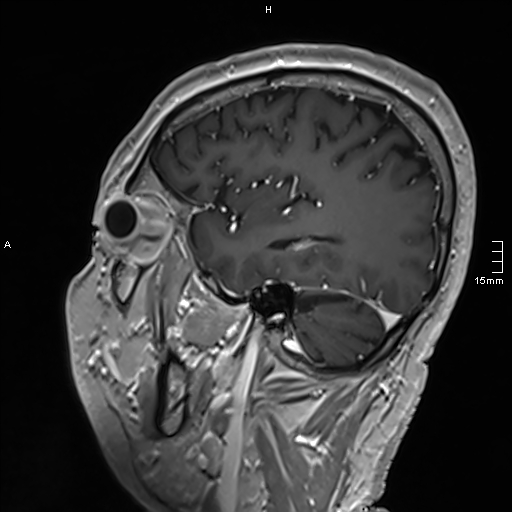 Neurosarcoidosis - involvement of the mesial temporal lobes (Radiopaedia 67429-76820 Sagittal T1 C+ 125).jpg