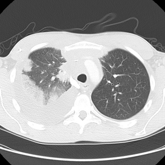 File:Non-Hodgkin lymphoma involving lung (Radiopaedia 29094-29470 Axial lung window 23).jpg