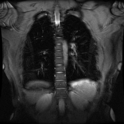 File:Non-compaction of the left ventricle (Radiopaedia 38868-41062 Coronal SSFP 2D FS 1).jpg