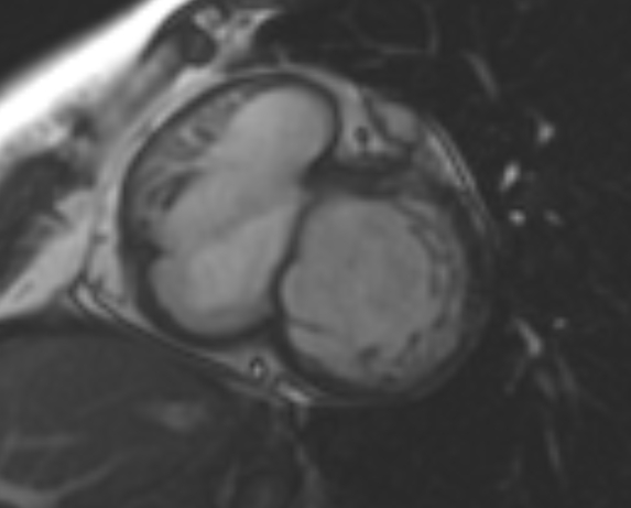 File:Non-compaction of the left ventricle (Radiopaedia 69436-79314 Short axis cine 172).jpg