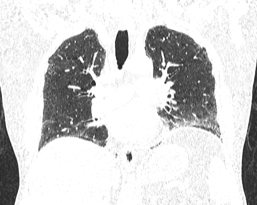 Non-specific interstitial pneumonia (NSIP) (Radiopaedia 68599-78228 Coronal lung window 49).jpg