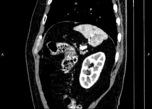Non-syndromic pancreatic endocrine tumor (Radiopaedia 86958-103178 E 84).jpg