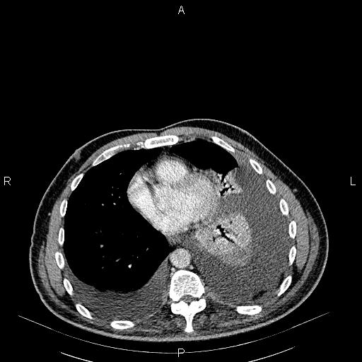 File:Non Hodgkin lymphoma in a patient with ankylosing spondylitis (Radiopaedia 84323-99621 B 22).jpg