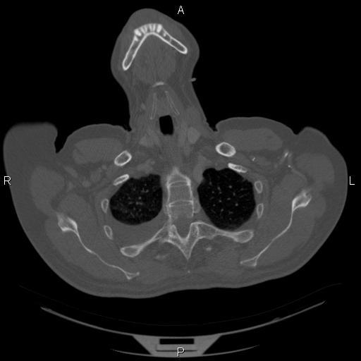 Non Hodgkin lymphoma in a patient with ankylosing spondylitis (Radiopaedia 84323-99624 Axial bone window 5).jpg