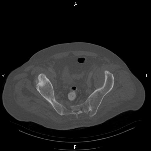 Non Hodgkin lymphoma in a patient with ankylosing spondylitis (Radiopaedia 84323-99624 Axial bone window 57).jpg