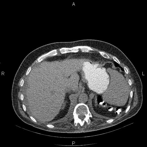 File:Non Hodgkin lymphoma in a patient with ankylosing spondylitis (Radiopaedia 84323-99624 Axial non-contrast 30).jpg