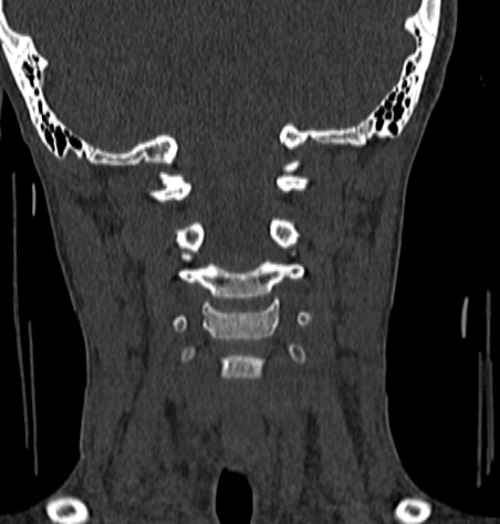 File:Normal CT cervical spine - 12-year-old (Radiopaedia 55352-61775 Coronal bone window 93).jpg