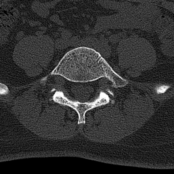 File:Normal CT lumbar spine (Radiopaedia 53981-60118 Axial bone window 59).jpg