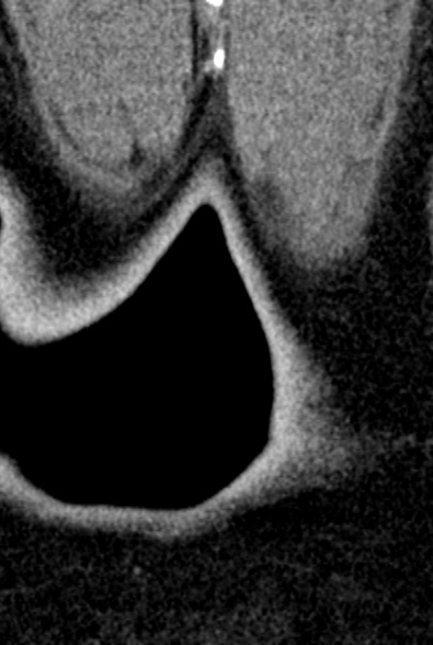 Normal CT lumbar spine (Radiopaedia 53981-60118 F 114).jpg